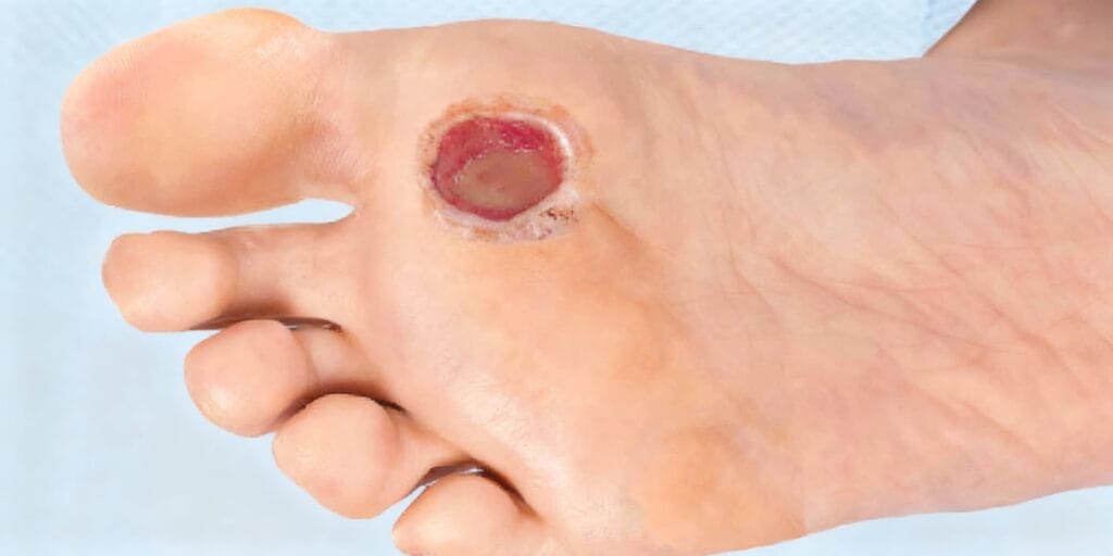 Evde Diyabetik Ayak Yara Bakımı