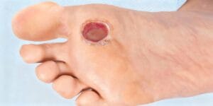 Evde Diyabetik Ayak Yara Bakımı