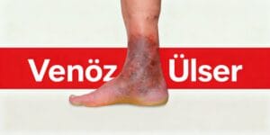 Venöz Ülser Nedir? Bacak Yaralarında Modern Tedavi Yöntemleri